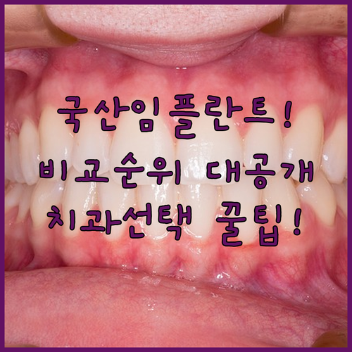 임플란트 국산 브랜드 순위 | 나에게 맞는 제품과 치과 선택 방법